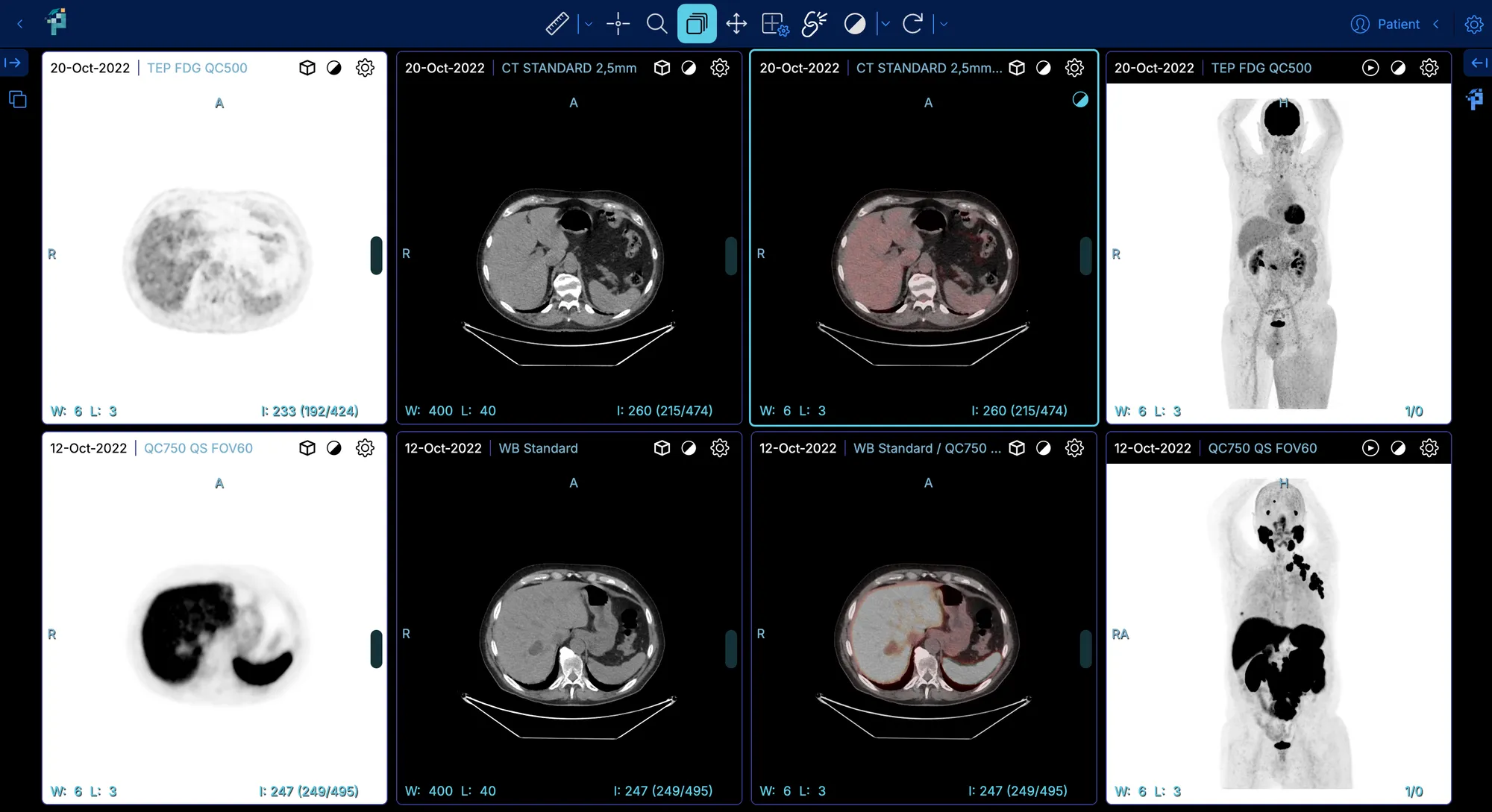 Cas de TEP/TDM ouvert dans le viewer d'imagerie PixiLearn : coupes TEP, TDM, fusion et projections MIP